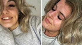 Arianna Kent allergie au froid