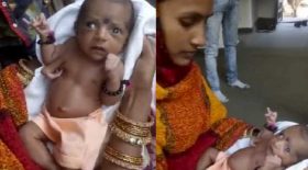 bébé né avec trois bras shiva