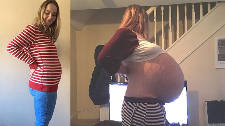 Elle pensait être enceinte mais elle avait un kyste de 26 kilos ...
