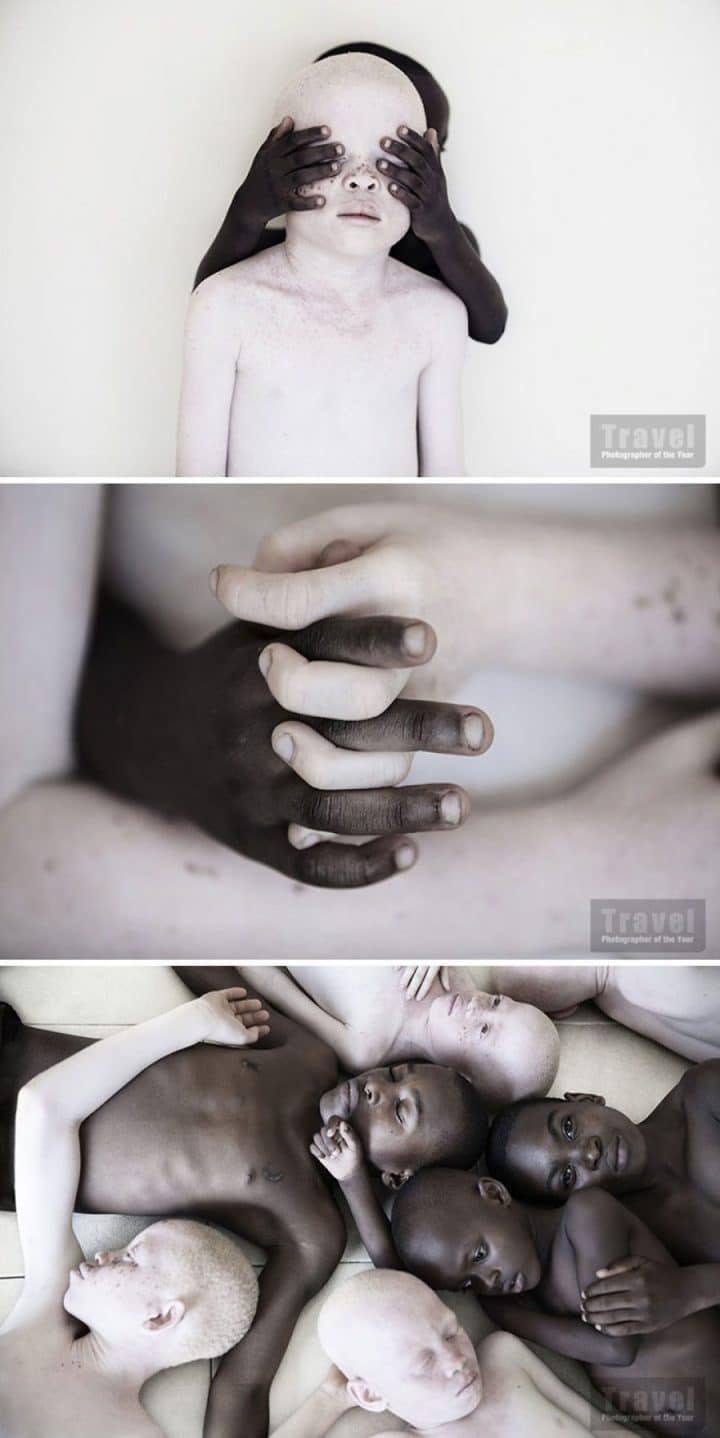 Enfant albinos