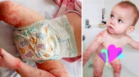 bébé virus herpès mourir bisou sur la bouche