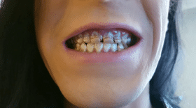 dents-monster-energy-pourries