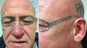 tatouage lunettes après soirée alcoolisée laser