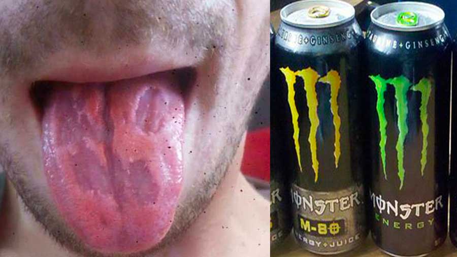 Accro aux boissons énergisantes, sa langue se désagrège à cause des ingrédients chimiques