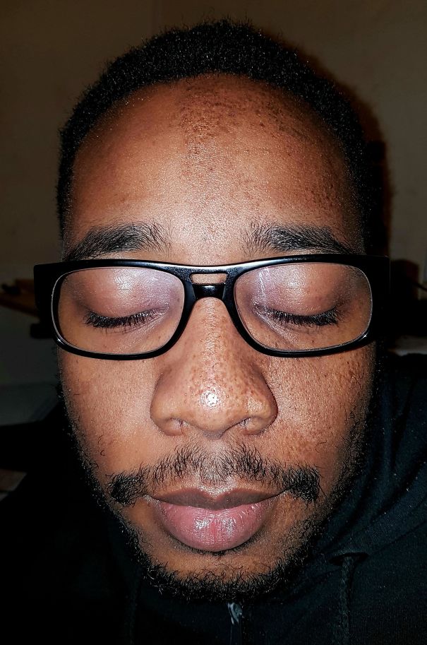 taches-rousseur-moitie-face