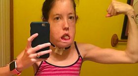 elle ne peut pas fermer les yeux hygroma kystique nerfs faciaux