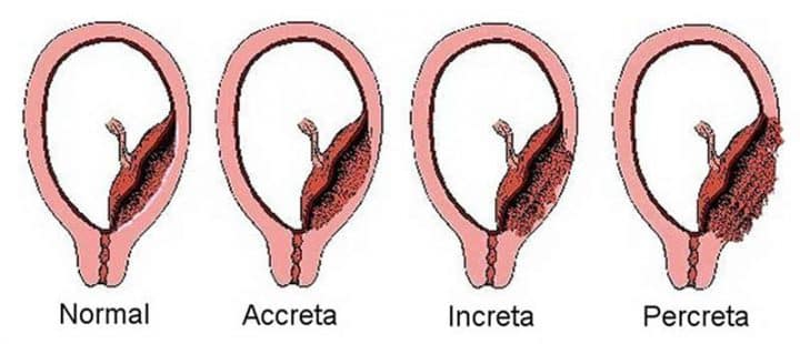 placenta accreta