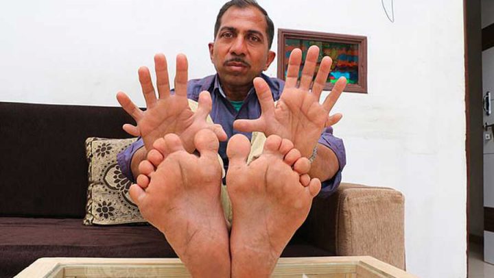 polydactylie pieds mains orteils doigts