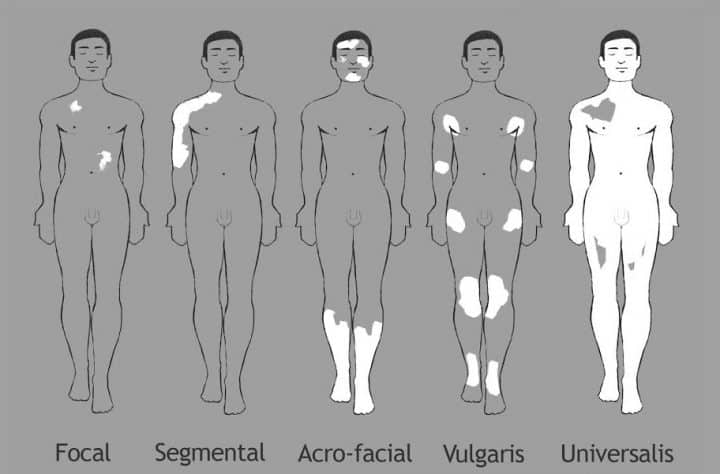 types-vitiligo