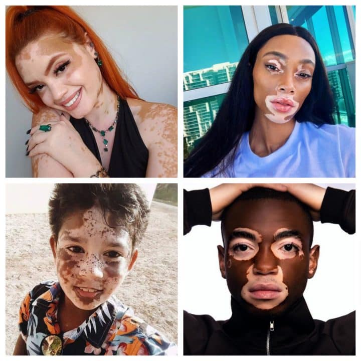 vitiligo