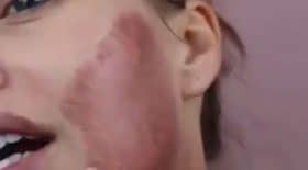 elle-se-brule-le-visage-pour-avoir-une-plus-belle-peau