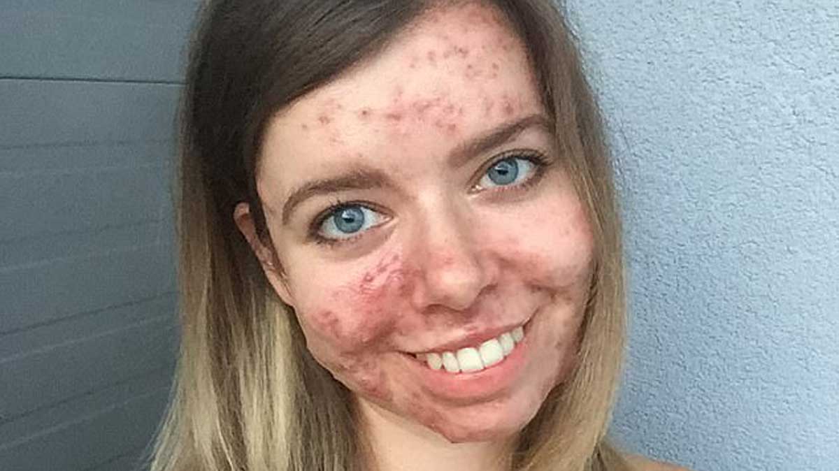 Pour donner du courage aux femmes, elle dévoile son visage touché par  l’acné depuis qu’elle a arrêté la pilule