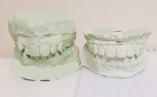 appareil orthodontique