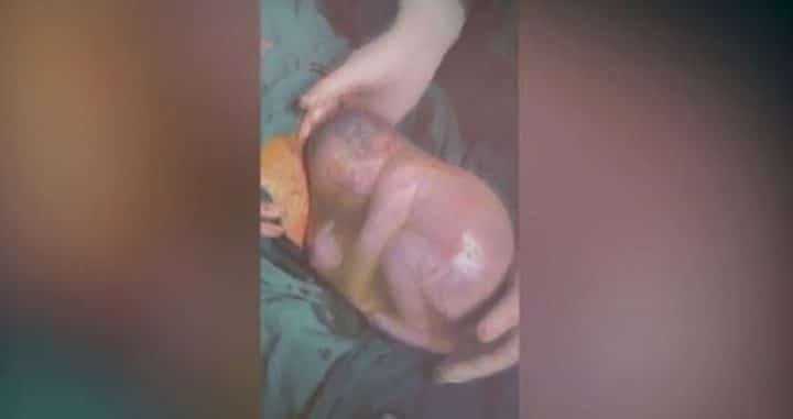 incroyable-un-bebe-premature-est-retire-du-ventre-de-sa-mere-dans-sac-amniotique