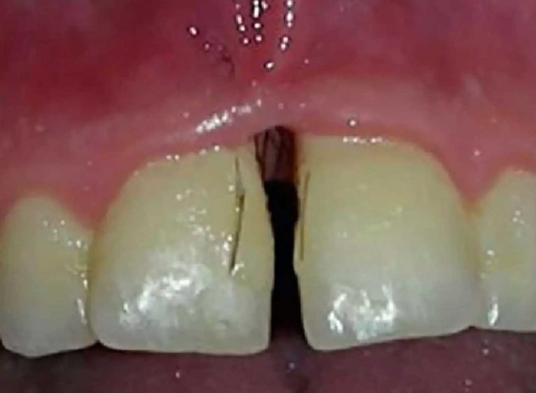 Des poils lui poussent entre les dents : un cas extrêmement rare de