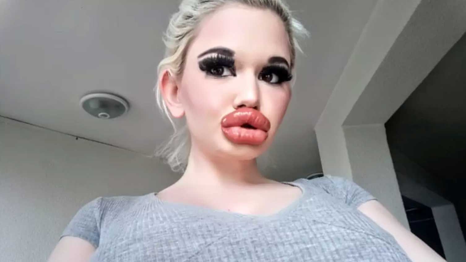 La femme aux lèvres les plus grosses du monde en est à ses 20e injections et compte continuer La femme aux lèvres les plus grosses du monde en est à ses 20e injections et compte continuer