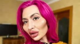 Cette femme fait des injections d'acide hyaluronique à outrance