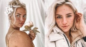 femme acné commentaires