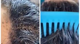 Elle montre une vidéo de son crâne infesté de poux