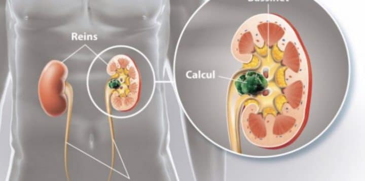 Colique-Néphrétique