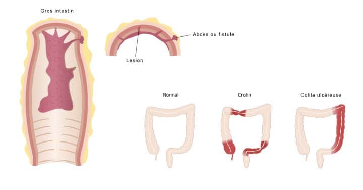 Maladie-de-Crohn