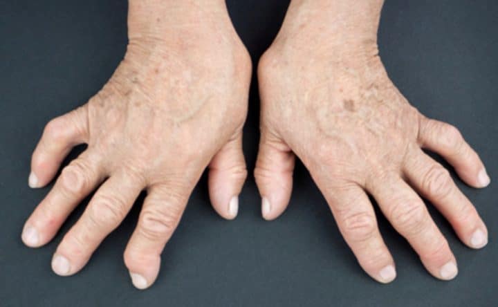 polyarthrite-rhumatoïde