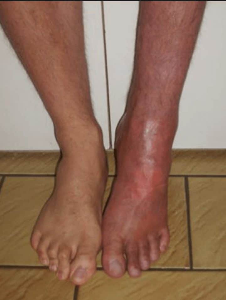 Syndrome-douloureux-régional-complexe