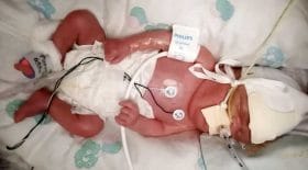 un bébé survit au coronavirus et e.coli
