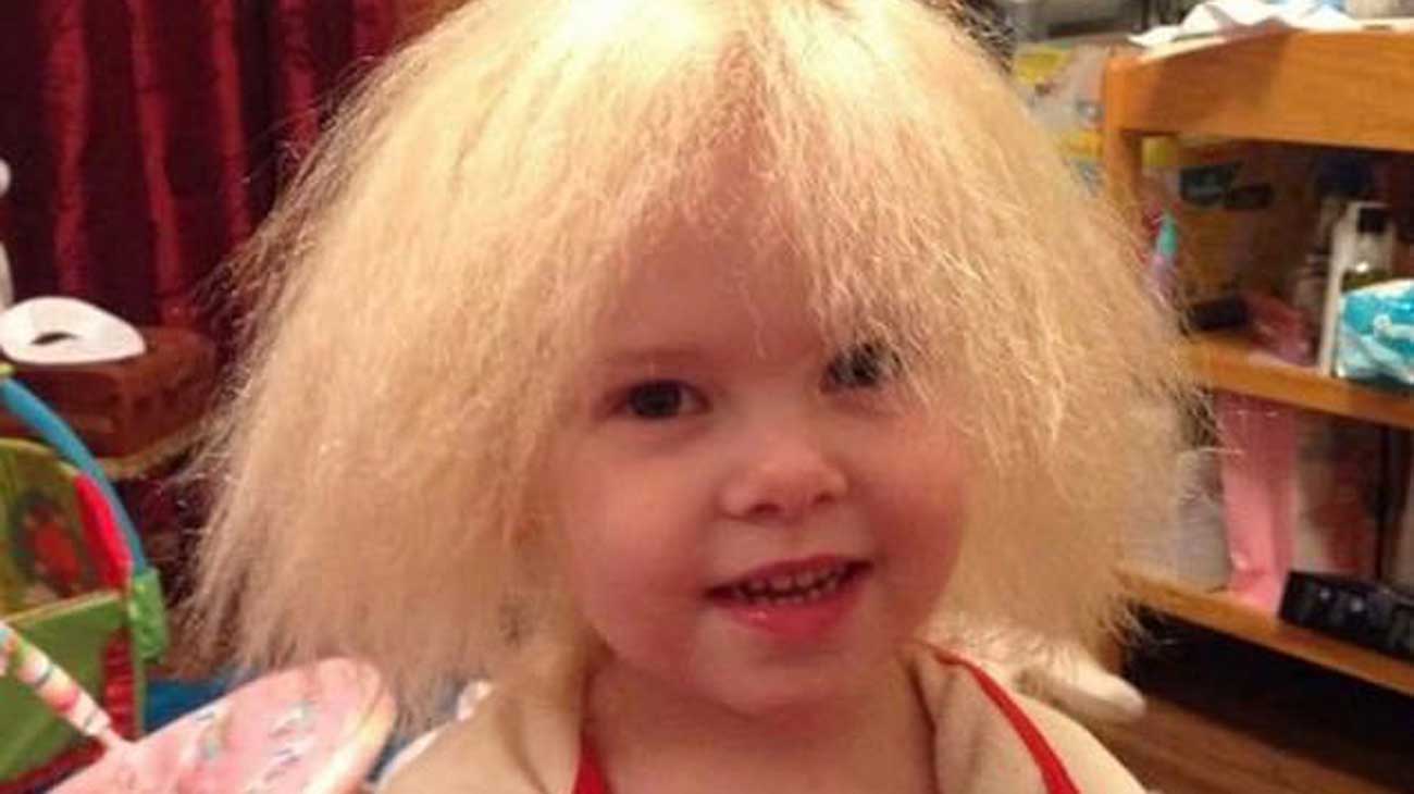 Une fille qui souffre du syndrome des cheveux incoiffables a les