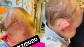 enfant 15 mois crèche visage tuméfié tpmp