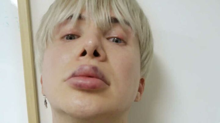 lèvres botoxées chanteur k-pop
