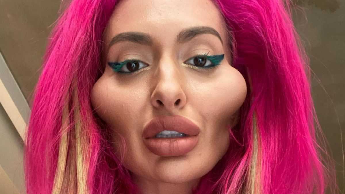 La Femme Aux Plus Grosses Pommettes Du Monde Compte Continuer La Chirurgie la-femme-aux-plus-grosses-pommettes-du-monde-compte-continuer-la-chirurgie