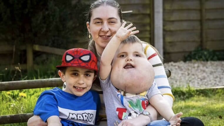 enfant kyste au visage