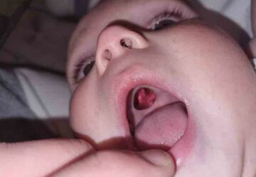 trou bouche palais enfant