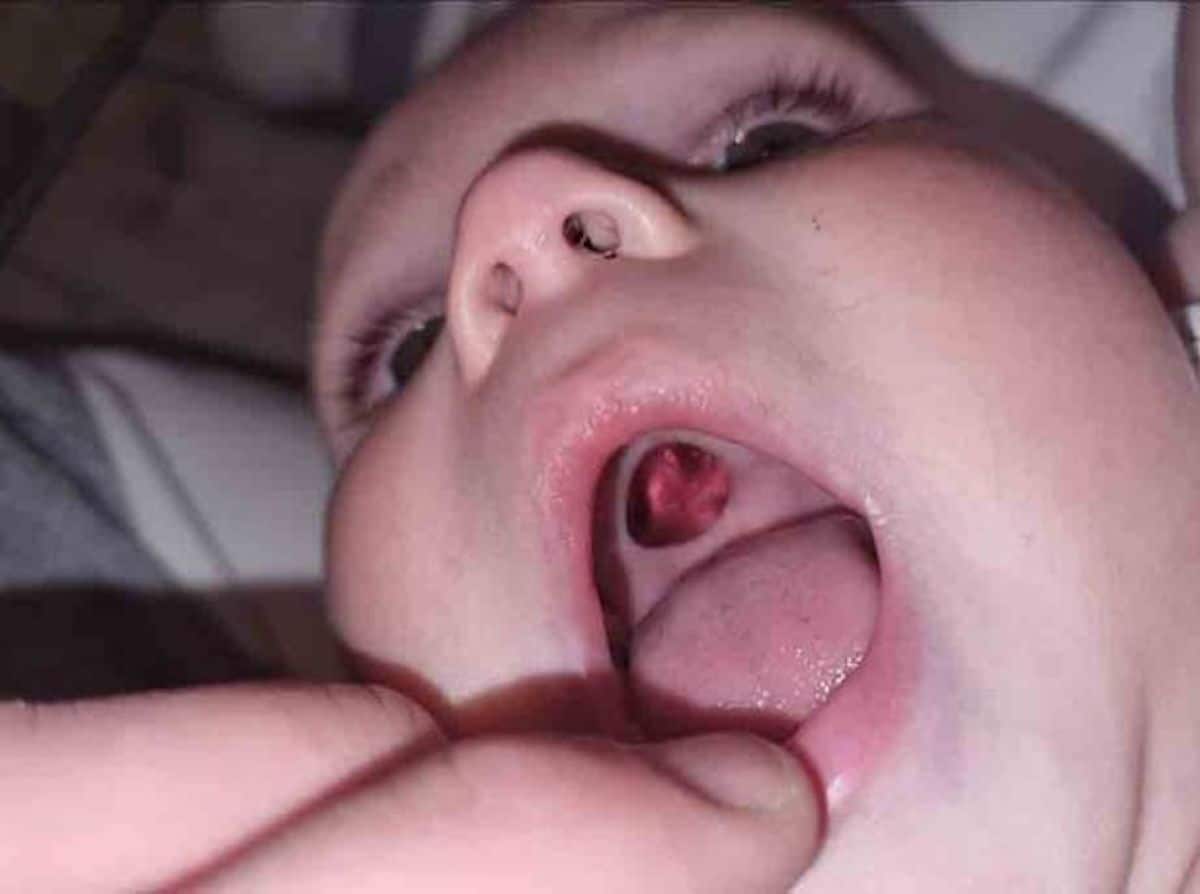 Elle Decouvre Que Son Bebe A Un Trou Dans La Bouche Elle Panique Et Fonce A L Hopital