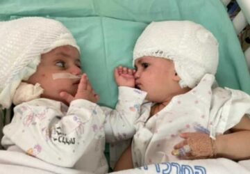 Des sœurs siamoises israéliennes d’un an ont pu se voir pour la première fois après la réussite d’une périlleuse opération de séparation