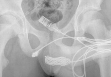Insolite : Un adolescent s'introduit 10 cm de câble USB dans le pénis ! Il finit aux urgences !