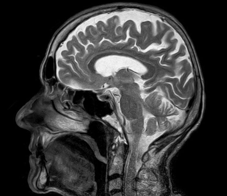 covid-19 cerveau