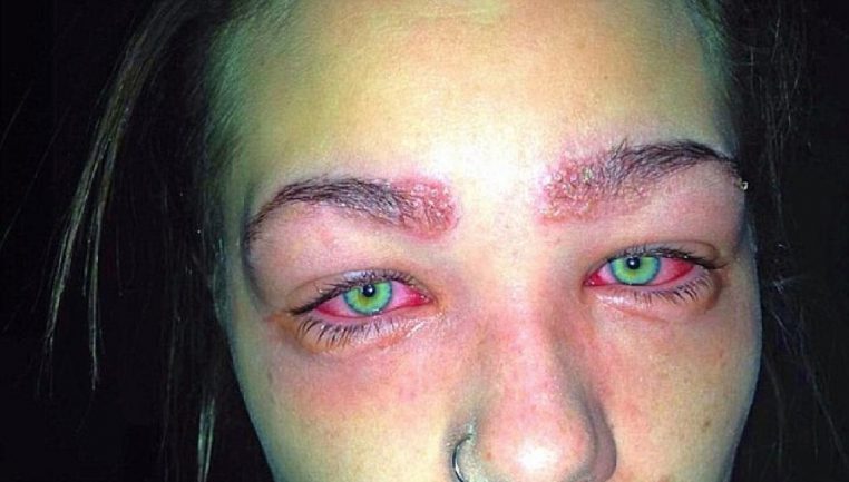 Une adolescente a failli devenir aveugle à cause d'une teinture pour sourcils