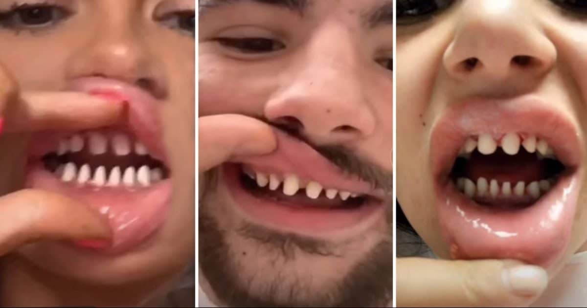 limer dents