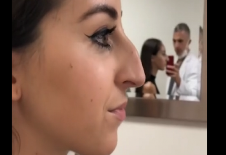 Une jeune femme complétement métamorphosée par une rhinoplastie ! (vidéo)