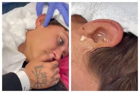 Elle se fait retirer un cafard coincé dans son oreille...