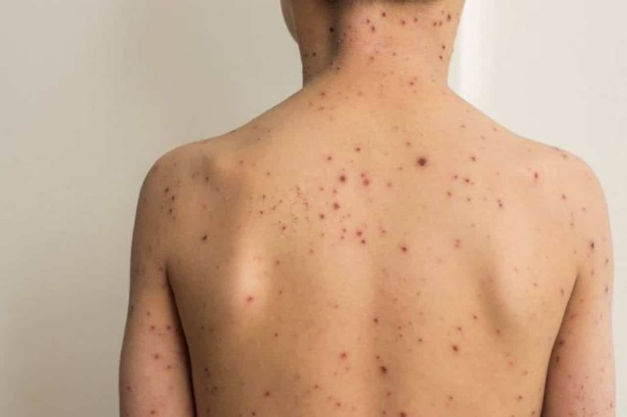 boutons variole