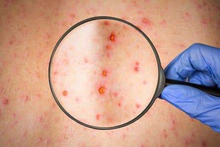 Variole du singe comment savoir si on l'a attrappé (2)