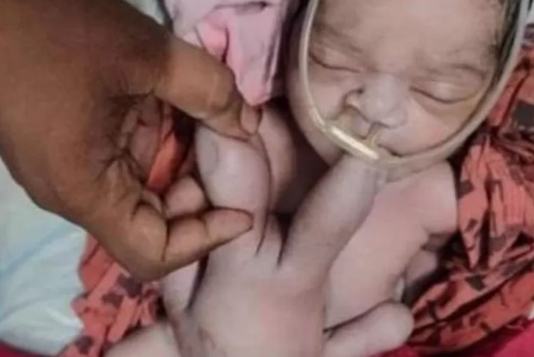 bébé quatre bras quatre jambes