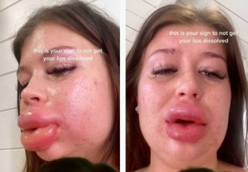 tiktok levres operation chirurgie esthetique