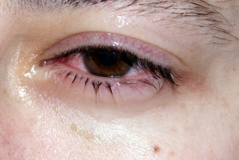 variole du singe nouveau symptome yeux