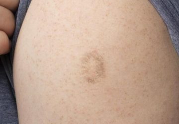 vaccin variole