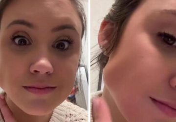 botox