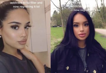 chirurgie esthétique tiktok lèvres injections